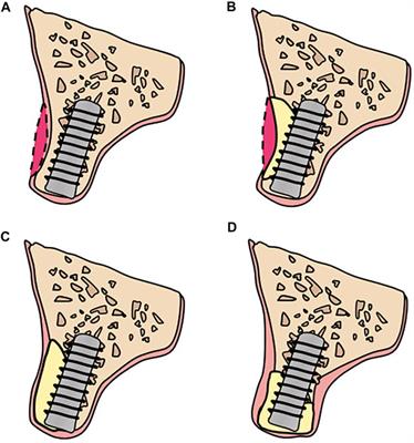 Customized Barrier Membrane (Titanium Alloy, Poly Ether-Ether Ketone and Unsintered Hydroxyapatite/Poly-l-Lactide) for Guided Bone Regeneration